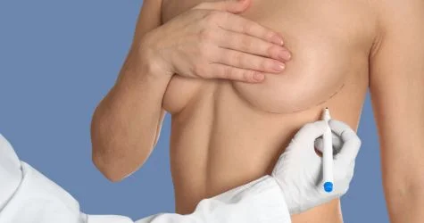 Doctor drawing lines on patient, for incision of a breast augmentation