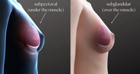 menu-breastimplant-placement